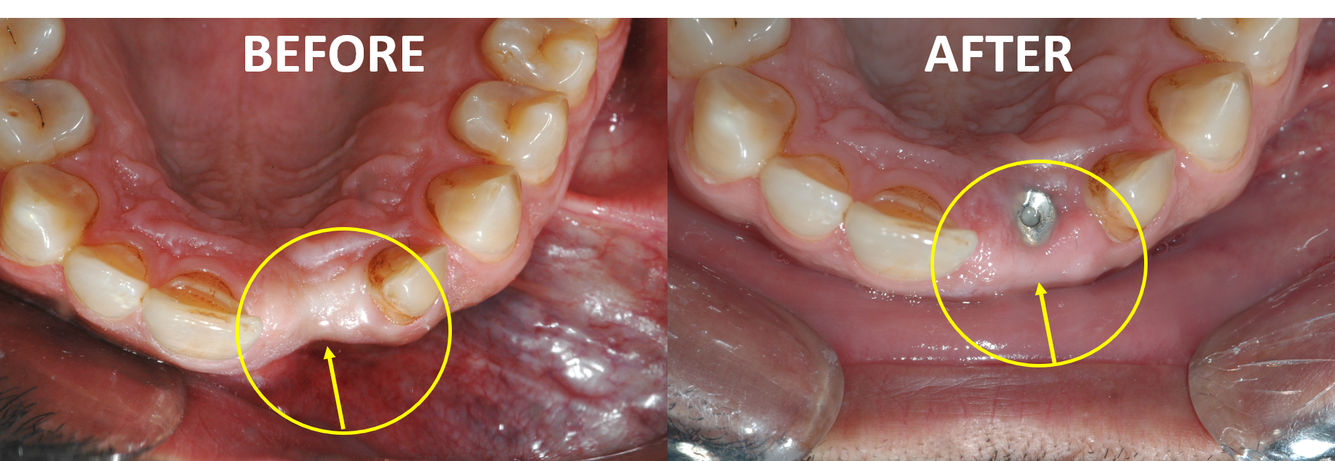 Minimally Invasive Dental Implant Surgeries