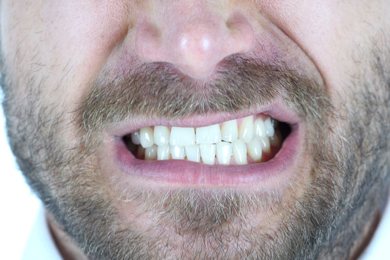 Dental Patient Grinding His Teeth - Bruxism
