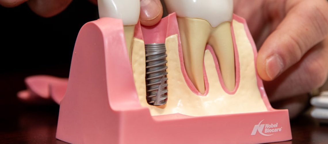 Dental Implant Model