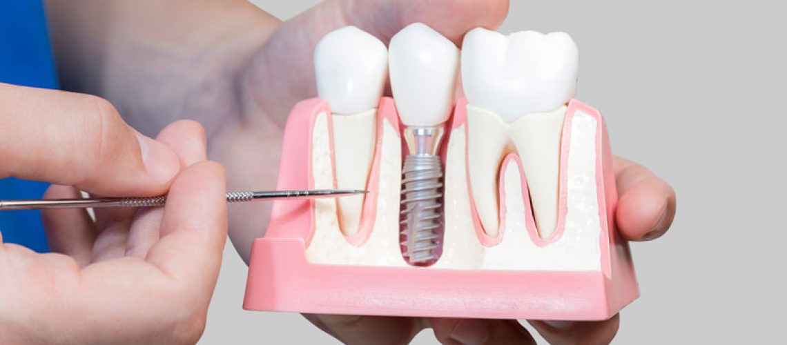 Dental Assistant Showing Off A Dental Implant In A Jawbone Cutaway Model in San Francisco, CA